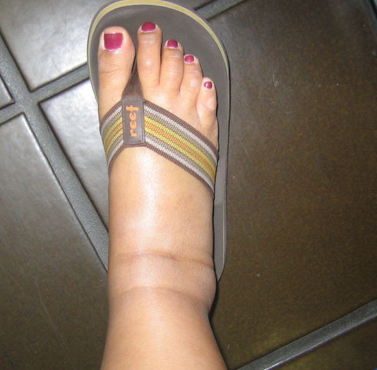 My swollen feet, calves and ankles-- you can't even tell I have ankles!