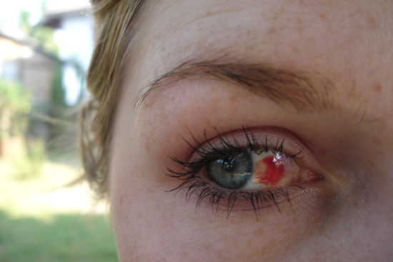 bloody eye after the bumpy busride...monstrous