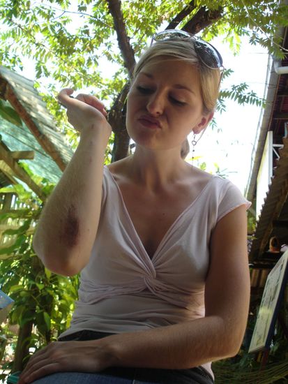 bike crash injuries...